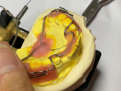 Perangkat ortodontik yang dibuat khusus dengan retensi yang baik dan fitur yang dapat disesuaikan