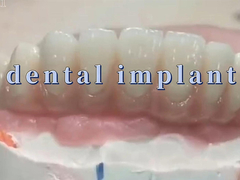 Titanium Dental Implant Mahkota Dan Jembatan Untuk Restorasi Gigi Dan Penggantian