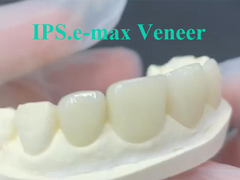 EMAX Veneer Solusi Ide untuk Restorasi Gigi yang Berkelanjutan dan Estetis