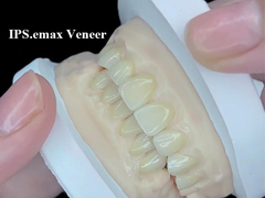 IPS.emax Veneer Premium Solusi Estetika Untuk Transformasi Senyum Menakjubkan