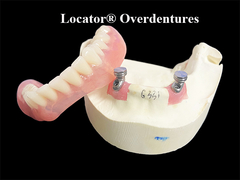 Overdentures lokator dirancang untuk memberikan stabilitas optimal dan retensi untuk kehilangan gigi
