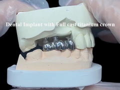 Full cast titanium crown Dental Implant molar untuk penggantian gigi yang hilang