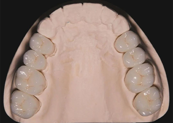 Beli Dental Restoration Gigi Zirconia mahkota gigi dibuat oleh laboratorium gigi Cina online manufacture