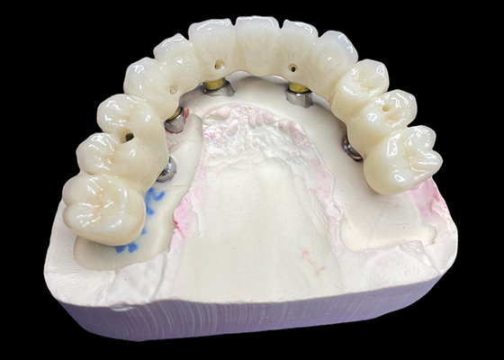 Beli Mahkota dan Jembatan Implantasi Gigi Lengkung Lengkap Memulihkan Fungsi dan Estetika dengan Solusi Canggih online manufacture