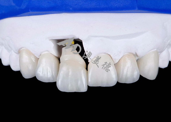 Beli Mahkota Implantasi Gigi Dengan Titanium Abutment Untuk Senyum yang Tampil Alami online manufacture