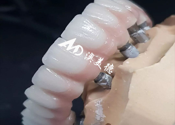 Beli Eksklusif Implan Gigi Berkinerja Tinggi Crown Bridge Berbagai Ukuran Tersedia online manufacture