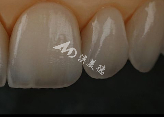 Beli Ketahanan Celah Zirconia Dental Crown Untuk Gigi Depan / Gigi Belakang online manufacture