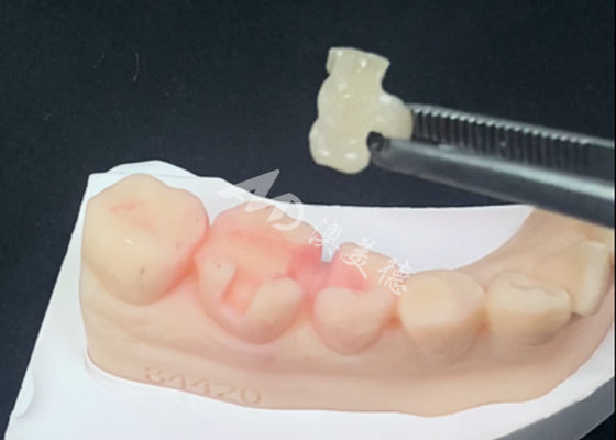 Beli Inlay Onlay Keramik Emax Restorasi Gigi untuk Warna Gigi Alami online manufacture