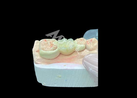 Beli Zirconia Crown dengan HPP Bonded Bridge untuk Peningkatan Estetika Senyum dan Biokompatibilitas online manufacture