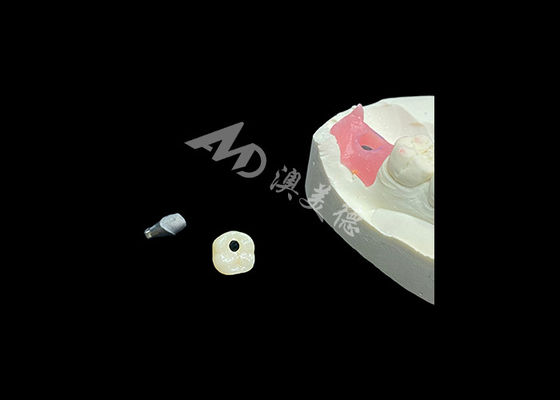 Beli Mahkota Implan Gigi Mengubah Prosedur Restorasi Kedokteran Gigi online manufacture