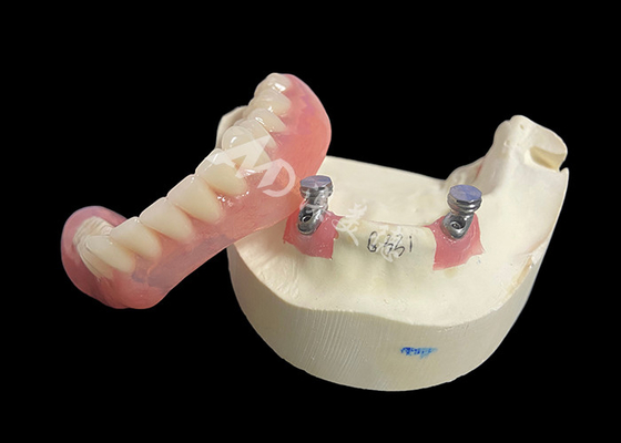 Beli Implant Locator Bar Overdenture Solution Untuk Memperbaiki Mengunyah Dan Bicara online manufacture