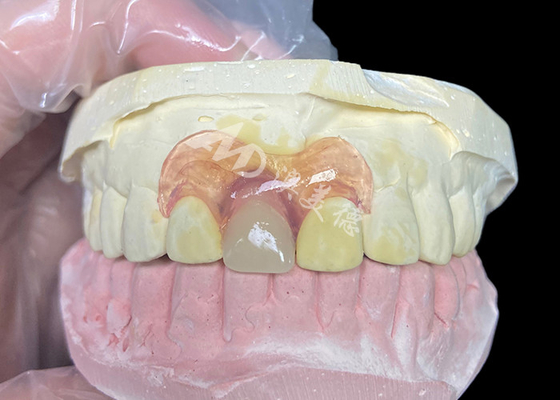 Beli Prosthetis parsial fleksibel Nesbit untuk pisau potong yang menawarkan solusi penggantian gigi yang dapat dilepas tanpa jahitan online manufacture