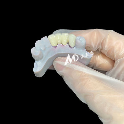 Beli Zirconia Dental Crown dengan Metal Post Core Menawarkan Aesthetics yang terlihat alami Adaptasi yang tepat dan Biokompatibilitas yang unggul online manufacture