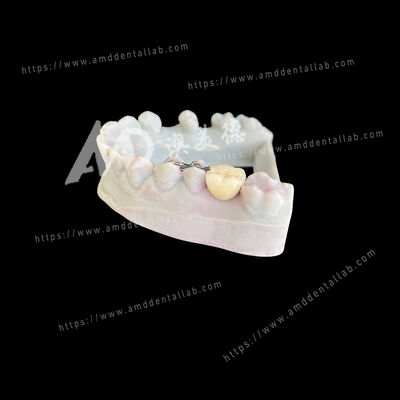 Beli PFM Maryland Jembatan Satu Pontic Dua Sayap Solusi Konservatif dan Estetika online manufacture