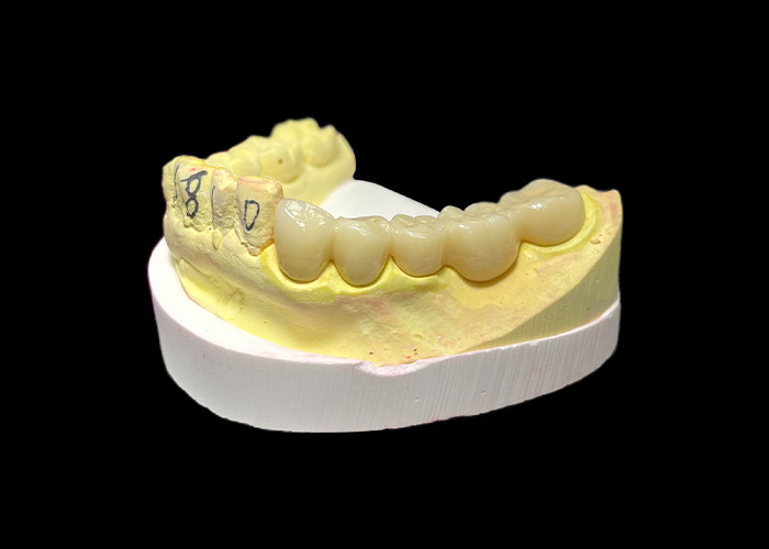 Premium Zirconia Porselen Dental Crown Kekuatan tak tertandingi Precision Fit dan Eksklusif Estetika dan Ketahanan