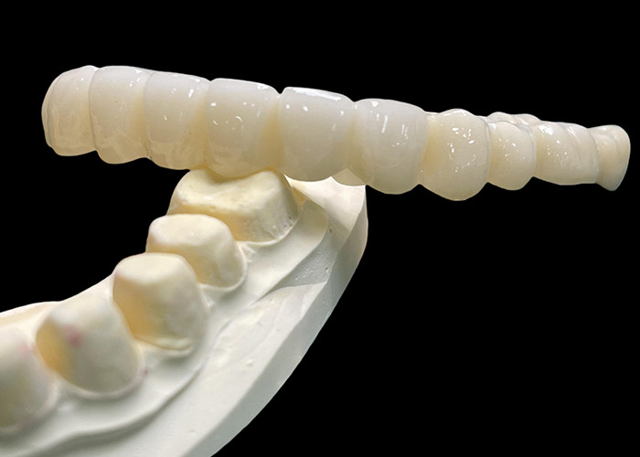 Vita Classical Shade All Ceramic Crown Bridge Natural Mencari Restorasi Gigi