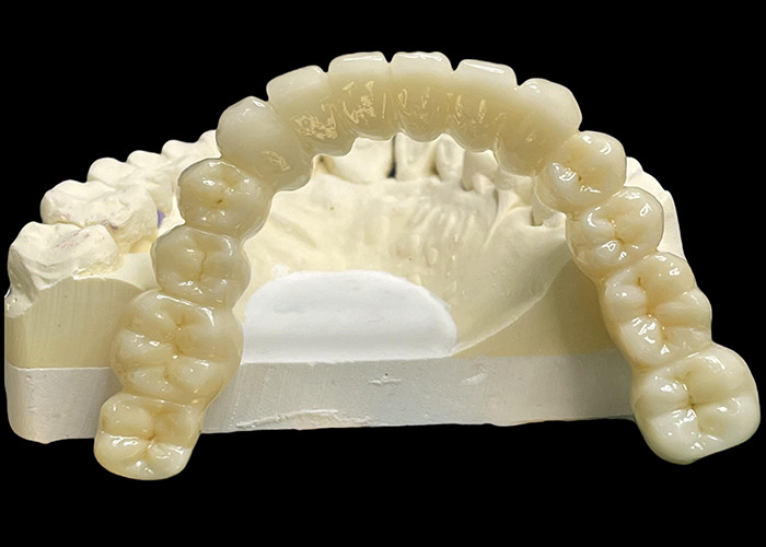 Vita Classical Shade All Ceramic Crown Bridge Natural Mencari Restorasi Gigi