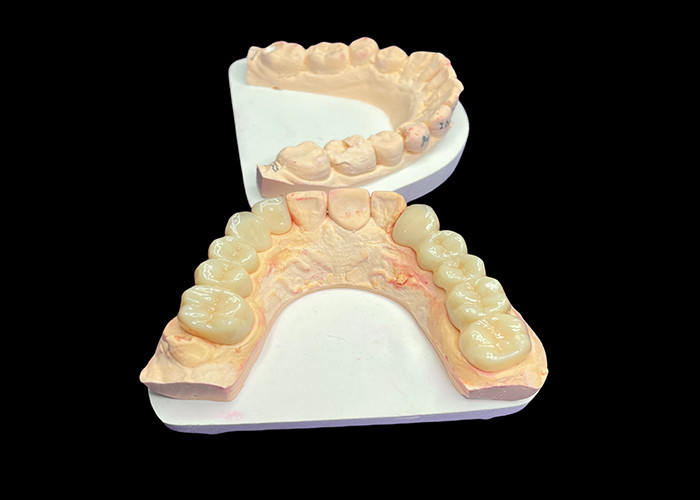 Natural Aesthetics Mahkota Keramik Translucent untuk Restorasi Gigi dengan Pembersihan Mudah dan Hasil yang Lama