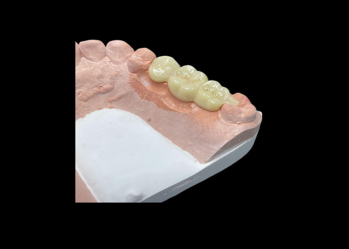 Natural Aesthetics Mahkota Keramik Translucent untuk Restorasi Gigi dengan Pembersihan Mudah dan Hasil yang Lama