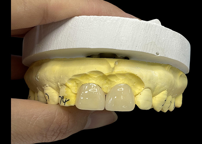 Porselen Shade Ultra Thin EMAX Veneers tahan noda untuk restorasi estetika