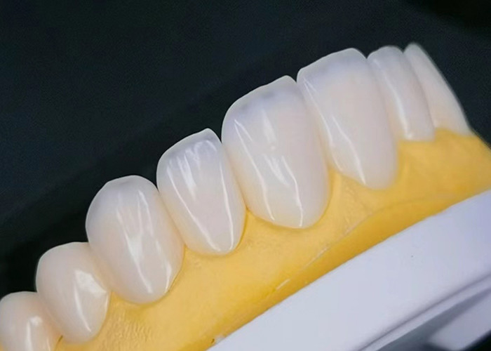 EMAX Porcelain Veneer dengan tahan noda untuk restorasi estetika yang terlihat alami