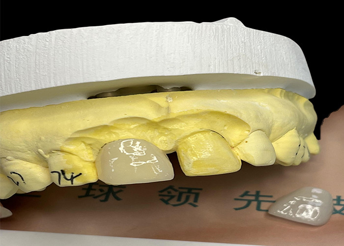 EMAX Porcelain Veneer dengan tahan noda untuk restorasi estetika yang terlihat alami
