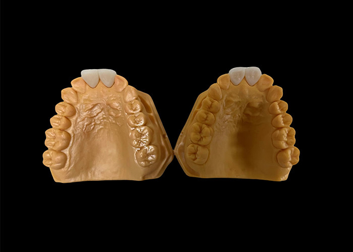 Customized Aesthetic Zirconia Dental Crown Cocok untuk Gigi Depan dan Belakang
