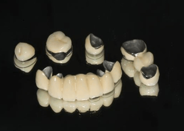 Porselen Dipecat ke Logam PFM Mahkota Dental Wear Resistance Untuk Restorasi Kedokteran Gigi