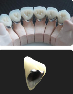 Porselen Dipecat ke Logam PFM Mahkota Dental Wear Resistance Untuk Restorasi Kedokteran Gigi