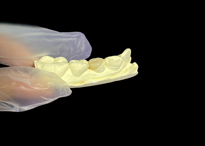 Keramik Dental Inlay Onlay untuk perbaikan gigi yang efektif dengan solusi porselen yang tahan lama dan estetis untuk restorasi jangka panjang