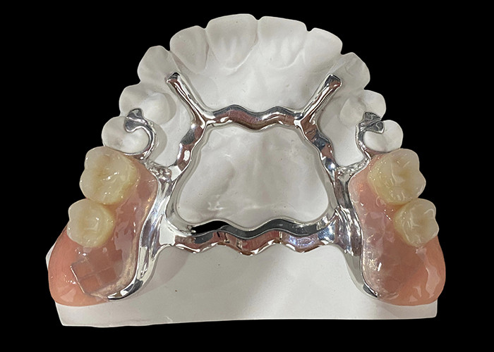 Dental yang bisa dilepas sebagian dengan basis logam dan resin akrilik untuk kebugaran dan penampilan alami