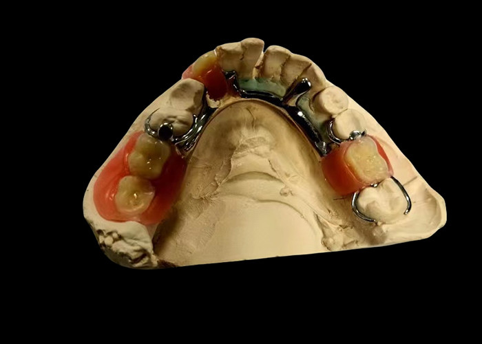 Dental yang bisa dilepas sebagian dengan basis logam dan resin akrilik untuk kebugaran dan penampilan alami