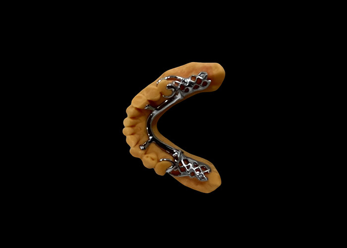 Dental yang bisa dilepas sebagian dengan basis logam dan resin akrilik untuk kebugaran dan penampilan alami