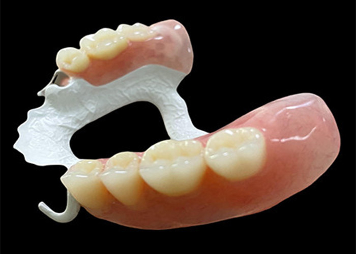 Dental yang dapat dilepas sebagian yang disesuaikan dengan kerangka polimer berkinerja tinggi (HPP) untuk kenyamanan dan daya tahan yang superior