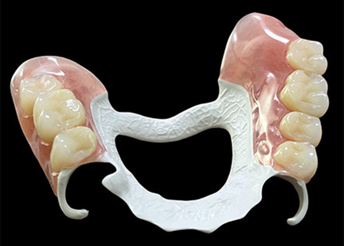 Dental yang dapat dilepas sebagian yang disesuaikan dengan kerangka polimer berkinerja tinggi (HPP) untuk kenyamanan dan daya tahan yang superior