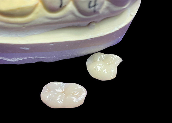 IPS e.max Keramik Inlays dan Onlays untuk Molar Restorasi Aesthetic alami dan daya tahan yang unggul untuk hasil yang tahan lama