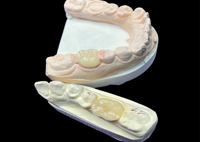 IPS e.max Keramik Inlays dan Onlays untuk Molar Restorasi Aesthetic alami dan daya tahan yang unggul untuk hasil yang tahan lama