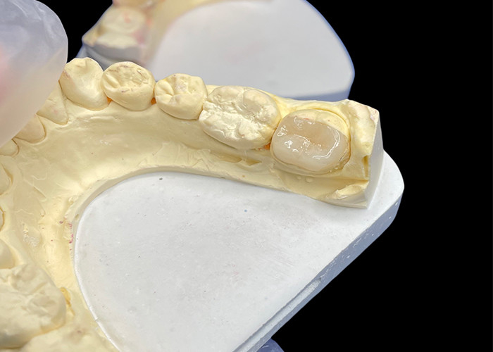 IPS e.max Keramik Inlays dan Onlays untuk Molar Restorasi Aesthetic alami dan daya tahan yang unggul untuk hasil yang tahan lama
