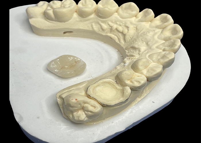 Keramik Dental Inlay Onlay untuk perbaikan gigi yang efektif dengan solusi porselen yang tahan lama dan estetis untuk restorasi jangka panjang