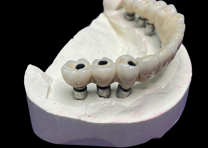 Implan gigi dengan dasar titanium di atasnya ada jembatan keramik yang indah untuk menciptakan restorasi yang sempurna.