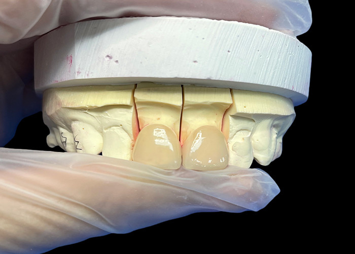 Precision Strength EMAX Porcelain Veneer incisor untuk restorasi estetika yang terlihat alami