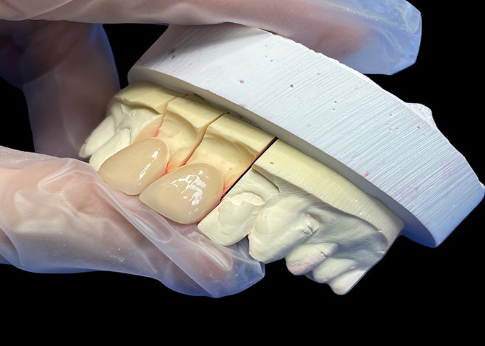 Precision Strength EMAX Porcelain Veneer incisor untuk restorasi estetika yang terlihat alami