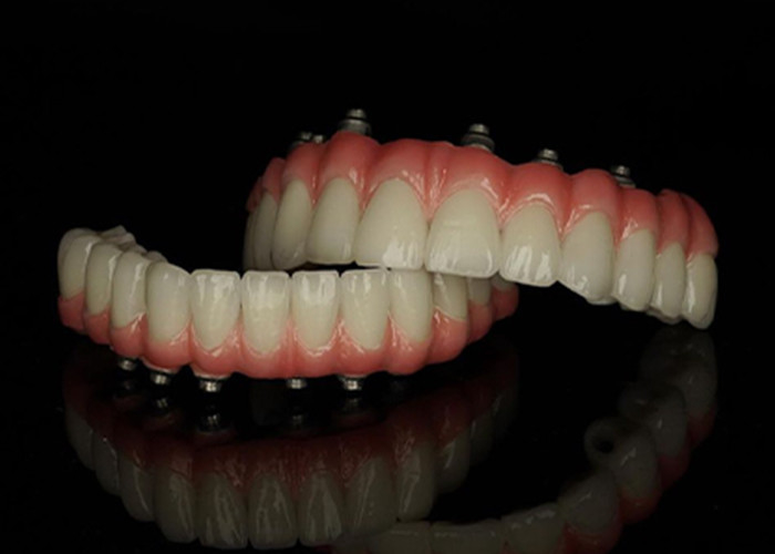Titanium Base Fixed Implant didukung gigi palsu dengan Keramik Crown Bridge Untuk menggantikan gigi yang hilang