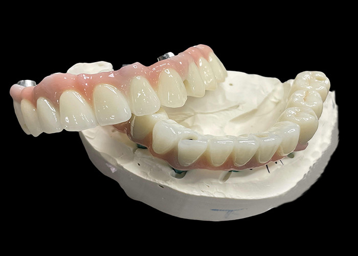 Titanium Base Fixed Implant didukung gigi palsu dengan Keramik Crown Bridge Untuk menggantikan gigi yang hilang