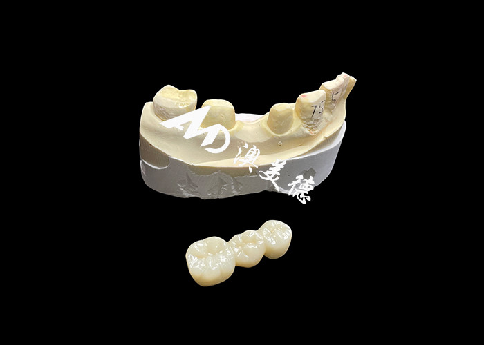 Mahkota Gigi Zirconia Estetika Kekerasan Tinggi dengan Translucence dan Resistensi Chipping dari China Dental Lab