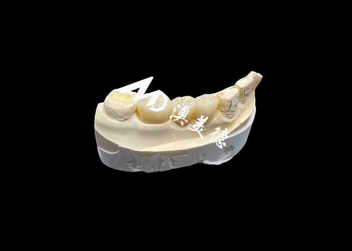 Mahkota Gigi Zirconia Estetika Kekerasan Tinggi dengan Translucence dan Resistensi Chipping dari China Dental Lab