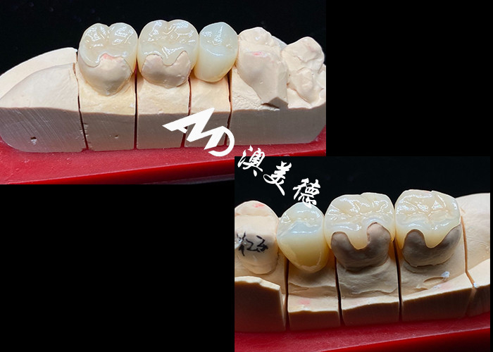 OEM Precision Fit Inlays Keramik Onlays untuk restorasi gigi yang tahan lama dan terlihat alami dengan kekuatan dan keandalan yang unggul