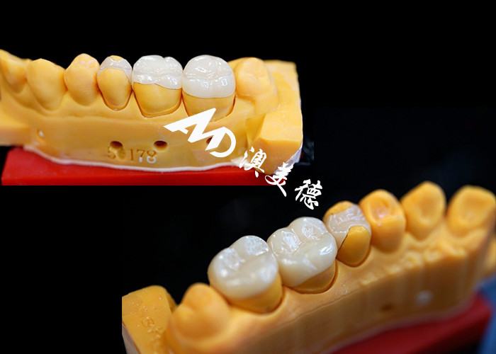 OEM Precision Fit Inlays Keramik Onlays untuk restorasi gigi yang tahan lama dan terlihat alami dengan kekuatan dan keandalan yang unggul