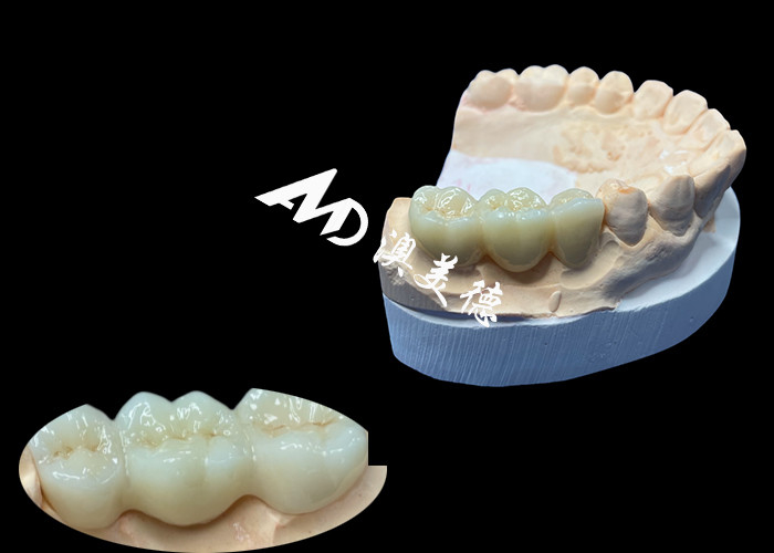 Warna alami Zirconia Dental Crown tahan retak untuk senyum sempurna dari China Dental Lab