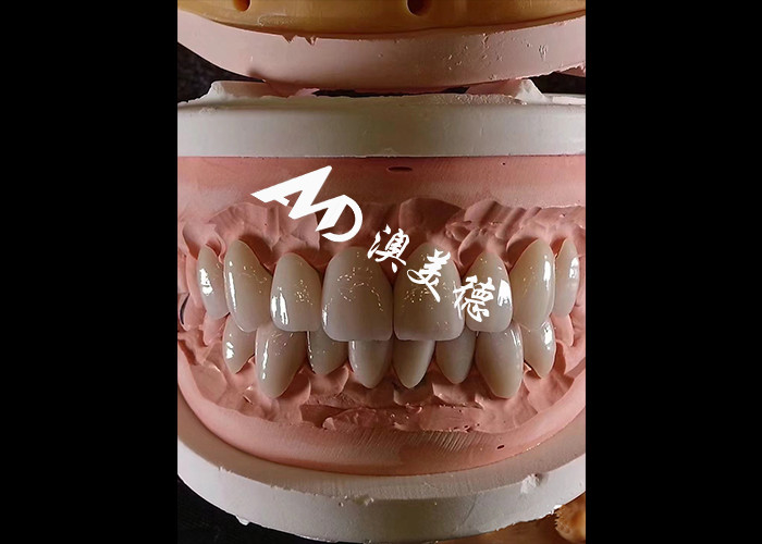 Kosmetik Kedokteran Gigi EMAX Dental veneers 0.3-0.5mm tebal Untuk restorasi estetika
